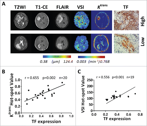 Figure 6. MRI pre-evaluation of TF expression reflected GVPs in GBM. (A) Different axial MR images showed the lesion of a 52-year-old female patient with TF strongly expressed GBM (top) and the lesion of a 53-year-old male patient with TF weakly expressed GBM (bottom). In both tumors, T1WI after intravenous administration of a contrast agent (CE-T1WI) demonstrates a region of bright signal corresponding to GBM, with necrosis inside tumor. T2WI and T2-FLAIR well differentiated the cyst and peri-tumor edema from tumor parenchyma. In TF strongly expressed GBM, the corresponding slice of VSI map showed relative large microvessel size. The same slice of Ktrans map, revealed high permeability of contrast across the BBB into EES in tumor region. And vice versa in TF weekly expressed GBM. (B) Significant positive correlation between Ktrans hot-spot value and percentage area of TF expression in 20 GBM patients (r = 0.655, p < .001), and (C) between VSI hot-spot value and percentage area of TF expression in 19 GBM patients (r = 0.556, p < .001).