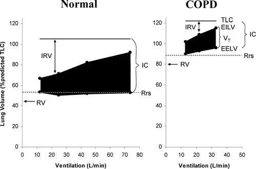 Figure 3 Changes in operating lung volumes are shown as ventilation increases with exercise in COPD (n = 105) and in age-matched normal subjects (n = 25). “Restrictive” constraints on tidal volume (VT, solid area) expansion during exercise are significantly greater in the COPD group from both below (reduced inspiratory capacity (IC)) and above (minimal inspiratory reserve volume (IRV). Other abbreviations: EELV = end-expiratory lung volume; EILV = end-inspiratory lung volume; Rrs = relaxation volume of the respiratory system; RV = residual volume; TLC = total lung capacity. With permission from O'Donnell DE, Webb KA. Mechanisms of dyspnea in COPD. In: Mahler DA, O'Donnell DE (eds). Dyspnea: Mechanisms, Measurement, and Management, 2nd edition. Lung Biology in Health and Disease Series, Volume 208, Chapter 3. New York: Taylor & Francis Group, 2005; pp. 29–58.