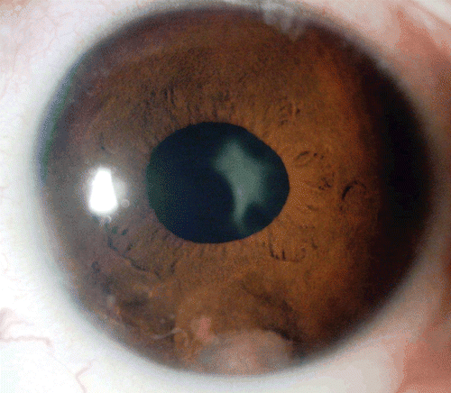 FIGURE 4  Slit lamp photo shows regression of the iris fungal granuloma after 6 months of anti fungal therapy.