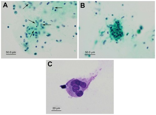 Figure 4 Vitreous cytology for case 2 with sarcoidosis. (A) epithelioid cells (arrows), and (B and C) multinucleated giant cells can be seen. Necrotic materials and malignant cells are not present. (A and B) Papanicolaou staining, (C) Giemsa staining.