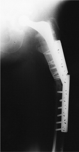 Figure 3. Broken DCP plate. The plate was used for the treatment of a Vancouver type B1 fracture.