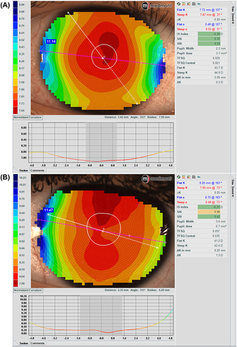Figure 1 Topography analysis covering the entire cornea in (A) (11.14mm) and up to a chord length of 11.47mm in (B).