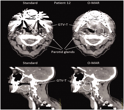 Figure 1. Two examples of delineations performed on the same CT scan of Patient 12 before and after reconstruction with O-MAR. Large differences in GTV-T can be seen in particular in the sagittal plan, where lack of signal in the standard CT impair tumor delineation.