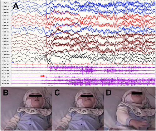 Figure 2 Electroclinical features of SRFMM in patient 1. (A) showed a sudden EMG burst of bilateral masticatory muscle followed by arousals at NREM stage 3 period during video-EEG monitoring. Red arrow indicates EMG bursts over bilateral masseter. (B-D) showed clinical manisfestations of crying and limbs lifting during SRFMM episode.