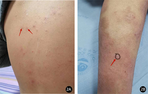Figure 2 (A and B) White pustules on the lower extremities and trunk (red arrow in (A and B)).