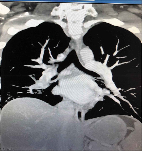 Figure 3. CT angio pulmonary showing right greater than left pulmonary emboli