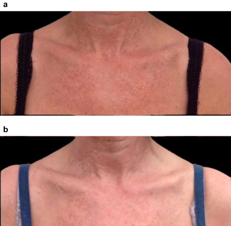 Figure 8 Décolletage: This 62-year-old female patient was treated with 1.5 mL of Radiesse® + 9 mL of saline (final dilution, 1:6). Radiesse® was delivered via 27 and 30 Gauge needle in a microbolus injection and a cannula with 50 mm-length and 25 Gauge-diameter (27 and 30 Gauge were both used for convenience and considering the body region). (a) At baseline, her décolletage skin thickness was very thin (grade 1) and the décolletage skin laxity and wrinkles were mild (grade 1 on the Merz scale). (b) The improvement reported at 3 months after 6 sessions of Radiesse® injection was good (grade 3).