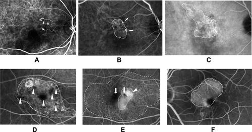 Figure 1 Representative examples of components seen on various types of images in age-related macular degeneration. (A) Early phase indocyanine green angiography (IA) shows irregular choroidal vessel or feeding vessels (arrowheads). (B) Typical nodular polyps (arrowheads) and branching vascular network contiguous to polyps (dotted line). (C) Late phase IA shows uniform hyperfluorescent legion or plaque (dotted line). (D) Leakage overlying and at boundaries of hyperfluorescence was seen in most inner line, consistent with the classic lesion. An area of granular hyperfluorescence, which is not as bright as a classic lesion, is seen in the lateral dotted line, consistent with an occult lesion. Hypofluorescence not corresponding to blood on color photographs is seen in several lesions (arrowheads). (E) Classic lesions are seen in most inner line (arrowhead). Hyperfluorescence from fibrous tissue is seen contiguous with the classic lesion, consistent with staining (inner dotted line). Hypofluorescence is seen contiguous to these (arrows). Moreover, window defect was seen around these components (outer dotted line). (F) Uniform fluorescence within area of pigment epithelial detachment is seen (dotted line).