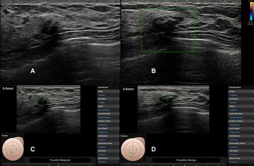 Figure 3 US images in a 40-year-old woman with fibroadenoma. Conventional ultrasound images show 13-mm hypoechoic mass with irregular shape and macrocalcification (A and B), which was classified as BI-RADS 4A. The CAD system diagnosed it as “possibly malignant” based on the image in the radial plane (C) and “probably benign” based on the image in the antiradial plane (D).