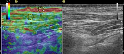 Figure 1 Sonoelastogram (left side) and B-mode ultrasound image (right side) of the TA tendon. B = subcutaneous area of fat taken into consideration for measuring the fat strain, A = area of the tendon which was taken into consideration for measuring the tendon strain. In this study, the fat tendon ratio = B/A.
