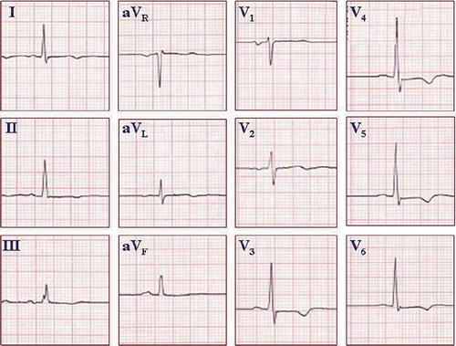 Figure 2. ECG manifestation of apical hypertrophic cardiomyopathy. ST segment and T wave abnormalities similar to repolarization abnormalities seen in ischemia are commonly observed in the antero-apical leads in apical hypertrophic cardiomyopathy. QRS voltage may not be as prominent as in obstructive or diffuse HCM. Paper speed 25 mm/s, gain 10 mm/mV.