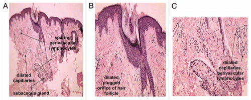 Figure 1 Pilosebaceous unit in facial skin of acne patients. Faintly hypertrophic sebaceous gland are observed. Dilated capillaries and perivascular lymphocytes (A and C) are early signs of inflammatory process in acne-involved skin. Dilated plugged orifice of hair follicle—sign of acne comedo (B).