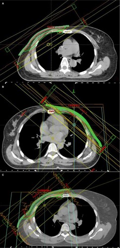 Figure 1 3D-CRT, F-IMRT, and I-IMRT treatment plans.Notes: (A) 3D-CRT, (B) F-IMRT, (C) I-IMRT.Abbreviations: 3D-CRT, three-dimensional conformal radiotherapy; F-IMRT, field in-field forward intensity-modulated radiotherapy; I-IMRT, inverse intensity-modulated radiotherapy.