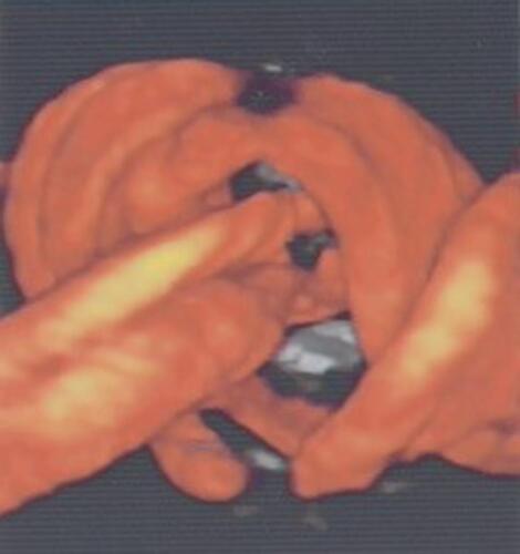 Figure 5 Three dimensional (3D) power Doppler image depicting true knot.Note: Reproduced with permission from Sherer DM, Dalloul M, Zigalo A, Bitton C, Dabiri L, Abulafia O. Power doppler and 3-dimensional sonographic diagnosis of multiple separate true knots of the umbilical cord. J Ultrasound Med. 2005;24:1321–1323. © 2016 by the American Institute of Ultrasound in Medicine.Citation67