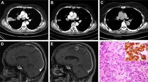 Figure 1 Contrast CT scan showed a 4.5 cm lobulated mass in the right upper lobe and multiple enlarged mediastinal lymph nodes (A). The lung lesions regressed dramatically with administration of crizotinib for 1 month (B) and 12 months (C). Brain MRI revealed multiple metastases in the cerebral hemispheres and cerebellum bilaterally (not shown) (D). However, the intracranial lesions progressed 12 months later (E). A core needle lung biopsy specimen revealed trabecular and solid nests with moderately abundant eosinophilic cytoplasm, and was positive for neuroendocrine markers (F, H&E ×200).