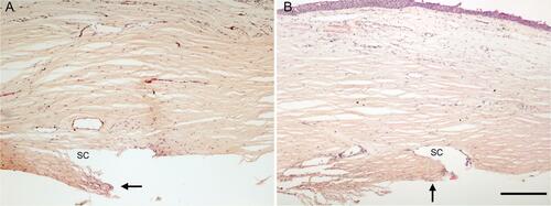 Figure 5 The anterior chamber angle following 360° Trabeculotomy resulted in incision through the trabecular meshwork (TM) proximate to Schwalbe’s line with no evident excision of TM leaflets. The arrows in (A and B) indicate large TM flap leaflets in two distinct sections of treated tissue. There is no apparent damage to the outer wall of the Canal of Schlemm in the treated areas. H&E stained section, scale bar = 200 µm.