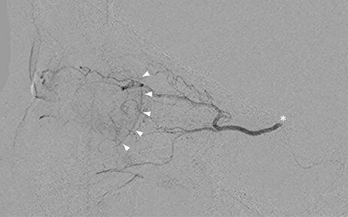 Figure 2 Lateral view of fluoroscope showing contrast media in ophthalmic artery and choroidal blush (arrow heads). The contrast was injected via microcatheter catheterized from internal carotid selectively into ophthalmic artery (asterisk).