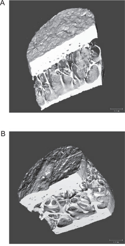 Figure 1 Teriparatide therapy improves skeletal architecture. Micro-CT scans of iliac crest biopsy specimens at baseline (A) and after 21 months of therapy (B) with teriparatide (20 μg/d). Reproduced with permission from CitationJiang Y, Zhao JJ, Mitlak BH et al 2003. Recombinant human parathyroid hormone (1–34) [teriparatide] improves both cortical and cancellous bone structure. J Bone Miner Res, 18:1932–41. Copyright © 2003 American Society for Bone and Mineral Research.