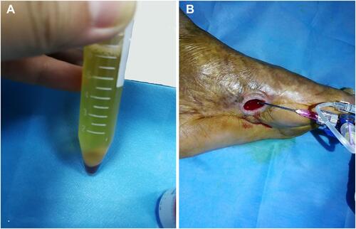 Figure 2 Autologous platelet-rich gel (APG) preparation and the topical administration over the wound bed. (A) APG was prepared after evaluation and informed consent obtained; (B) The gel was administered onto the surface of the wound.