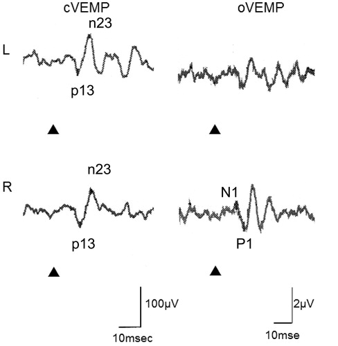 Figure 1. VEMP responses of Patient #1. He showed normal cVEMP bilaterally, however, he did not have oVEMP responses to the left ear stimulation. Stimuli were 500 Hz air-conducted short tone bursts (125 dBSPL) ▴: STB presentation.