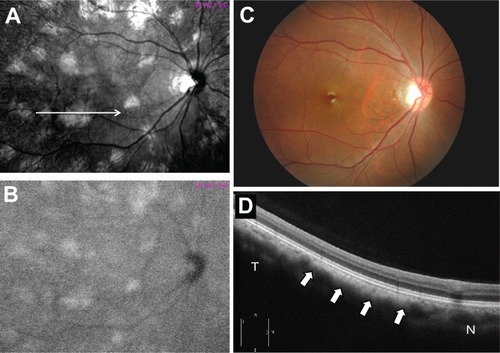 Figure 2 Fundus photographs of the right eye of case 1 by reflectance of a near-infrared monochromatic light resistance (A), near-infrared fundus autofluorescence (B), color fundus photograph (C), and optical coherence tomography (D). Near-infrared fundus autofluorescence (B) shows similar hyperfluorescent regions at locations identical to those revealed by near-infrared monochromatic light resistance (A).