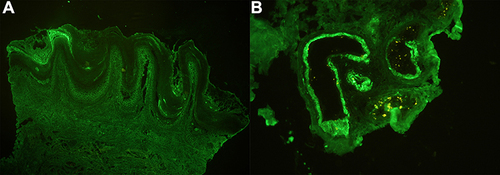 Figure 4 Direct immunofluorescence of PNP demonstrating intercellular deposition with IgG (A); perieccrine granular deposition of C3 (B).