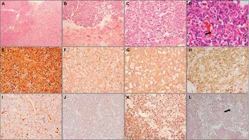 Figure 2 Histopathology and immunohistochemistry of AT/RT.Notes: Photomicrographs showing a heterogeneous tumor (A; HE, 100×) with areas of necrosis (B; HE, 100×) composed of small round cells admixed with cells with eosinophilic cytoplasm (C; HE, 200×); higher magnification shows typical rhabdoid cells (arrow) (D; HE, 400×). On IHC, tumor cells are positive for vimentin (E; IHC, 200×), EMA (F; IHC, 200×), synaptophysin (G; IHC, 200×), SMA (H; IHC, 200×), and focally for GFAP (I; IHC, 200×) and cytokeratin (J; IHC, 200×); MIB-1-LI is high (K; IHC, 200×) and tumor cells show loss of INI1, while endothelial cells (arrow) show retained expression (L; IHC, 200×).Abbreviations: HE, hematoxylin and eosin; IHC, immunohistochemistry; EMA, epithelial membrane antigen; SMA, smooth muscle actin; GFAP, glial fibrillary acidic protein; MIB-1-LI, MIB-1 labeling index; INI1, integrase interactor 1; AT/RT, atypical teratoid/rhabdoid tumor.