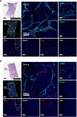 Figure 6 mIHC validation of cell infiltration in paired primary CRC and liver metastases. (A-B) H&E staining images and mIHC multispectral fluorescence images of paired primary CRC and liver metastases marked with the following six markers: α-SMA (sky blue), CD206 (green), CD8 (yellow), CD4 (red), FoxP3 (white), and DAPI (dark blue). The magnification of the tissue panorama is × 10, with a scale of 5 mm. The magnification of the enlarged local image is × 100, with a scale of 200 μm. The magnification of the enlarged image of Treg cells in the upper right corner is × 800, with a scale of 200 μm.