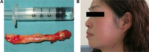 Figure 6 The resected giant elongated styloid process and the small cervical skin scar after extraoral approach.