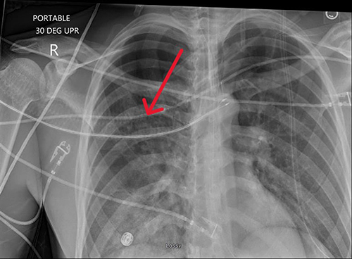 Figure 2 Chest x-ray on post-operative day 3. Red arrow pointing to resolution of consolidation present in Figure 1.