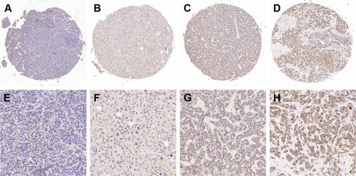 Figure 1 Immunohistochemical staining of NRP2 expression in HCC tissues with (A) negative, (B) weakly positive, (C) moderately positive, and (D) strongly positive in low magnification (40×); and (E) negative, (F) weakly positive, (G) moderately positive, and (H) strongly positive in high magnification (200×) under a microscope (Olympus, Tokyo, Japan).