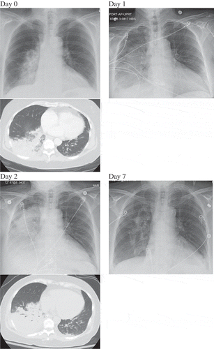 Figure 1. Lung imaging on admission (Hospital Day 0), Hospital Day 1, Day 2, and Day 7. It demonstrates progressively worsening right-sided infiltrates from Day 0 to Day 2 (CT chest available on Day 0 and Day 2). Significant improvement in infiltrates noted on Day 7.