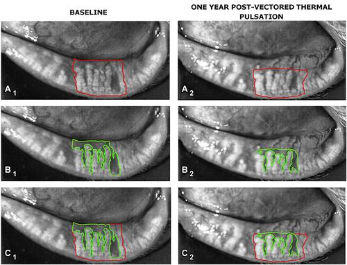 Figure 2 Subject 2: The first column shows the same dynamic meibomian images prior to VTP treatment with the total area analyzed (A1, red outline), the area of meibomian gland atrophy + interglandular space (B1, green outline), and (A1, B1) superimposed (C1). The second column shows the same dynamic meibomian images after VTP treatment in the same patient as the first column. (A2) indicates the total area analyzed (red outline), (B2) indicates the area of meibomian gland atrophy + interglandular space (green outline), and (C2) shows (A2, B2) superimposed.