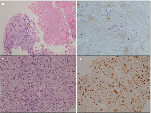 Figure 2 (A–D) Histopathology revealed (A) Tumor admixed with necrotic tissue (HE stain, 100x), (B) Gram-negative bipolar rods resembling safety pins (Brown-Hopp stain, 1000x), (C) Non-small cell carcinoma favor adenocarcinoma (HE stain, 200x), (D) TTF-1 immunohistochemistry positive nuclear staining (200x).