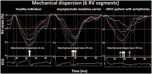 Figure 5. Mechanical dispersion in a healthy individual (left panel), an asymptomatic mutation carrier (mid panel) and an arrhythmogenic right ventricular cardiomyopathy patient with recurrent arrhythmias (right panel). Horizontal white arrow indicates contraction duration defined as the time from onset R to maximum myocardial shortening. Vertical arrows indicate the timing of maximum myocardial shortening in each segment. Right panel shows more pronounced mechanical dispersion. Modified from Sarvari et al.[Citation16]