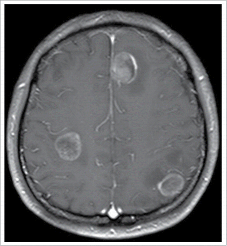 Figure 9. Brain magnetic resonance imaging suggested cerebral metastases.