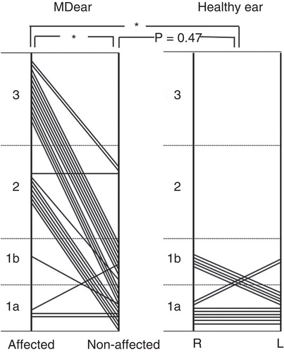 Figure 6. Distribution of the MICS (membranous image between the vestibular cecum of the cochlea and saccule) pattern in Meniere’s disease (MD) and healthy ears. For a description of MICS types, please refer to the legend for Figure 5. *p < 0.01.