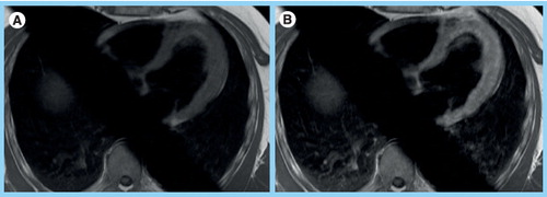 Figure 2. Axial T1-weighted spin echo images (A) before and (B) early after contrast administration in the same male patient with acute myocarditis as in Figure 1.Both images are from an axial stack of images that are obtained in an interleaved fashion over minutes before and after contrast to reflect accumulation in the interstitial space. (B) Note the increased myocardial signal intensity in the postcontrast image reflecting global left ventricular inflammation. Global relative enhancement was 4. Skeletal muscle in the right and left lower corner of the images is available for comparison. The body coil was used for image acquisition. The oblique saturation bars were applied to reduce aortic and atrial flow artifacts.