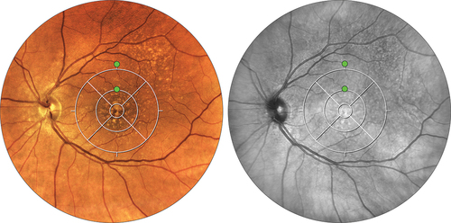 Figure 3. RMDA is affected near the fovea in eyes with subretinal drusenoid deposits (SDD).