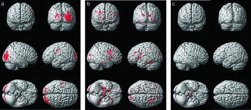 Figure 2.  Results of the voxel-wise comparisons of trace maps among the three subject groups, which include the cognitive normal, moderate chronic obstructive pulmonary disease (COPD), and severe COPD. Maps are superimposed on a three-dimensional surface rendering of a template brain (upper left: anterior view; upper right: posterior view, middle: lateral views, lower left: inferior view, lower right: superior view). The red color indicates a statistically significant difference in trace (false discovery rate lower than 5%, one-way ANOVA). A. Results from the comparison between the moderate COPD patient and the control group (Normal < Moderate COPD). B. Results from the comparison between the severe COPD patient and the control group (Normal < Severe COPD). C. Results from the comparison between the severe and moderate COPD patient group (Moderate COPD < Severe COPD).