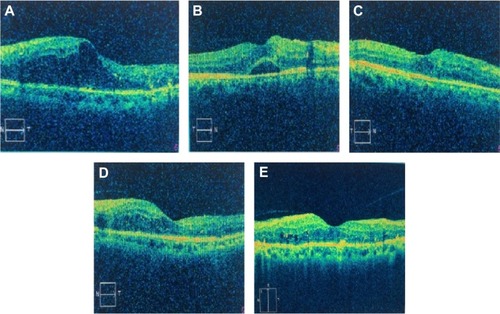 Figure 4 Changes of CMT in the observation group and the control group.Notes: A is before combined treatment; B, is after one month after retinal photocoagulation; C is six months after retinal photocoagulation; D is after one month combined treatment; and E is six months after combined treatment.