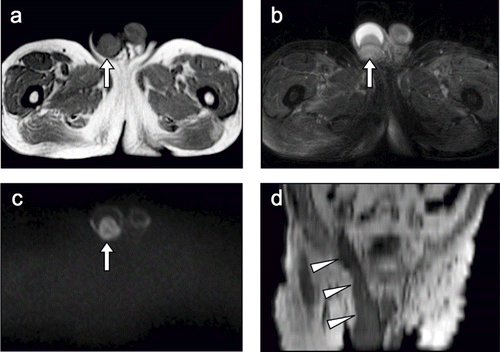 Figure 1. (A) T1-weighted image (T1WI) shows an enlarged right testis (52.5 mm × 43.1 mm) with relatively heterogeneous signal intensity (arrow). (B) T2-weighted image shows a large amount of fluid collected in the right testis (arrow). (C) Diffusion-weighted image shows a high signal intensity area in the right testis (arrow). (D) Abdominal, coronal, and multiplanar reconstruction T1WI shows the diffuse tumorous involvement extending from the right testis to the spermatic cord (arrowheads).