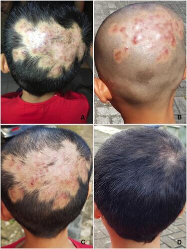 Figure 3 Clinical improvement from first (A), second (B), third (C), and last visit (D).