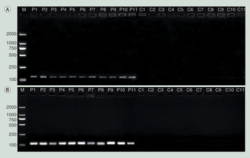 Figure 4.  For sperm from the hepatitis B virus-infected patients and controls, aliquots of the bisulfite sequencing PCR amplified products were subjected to electrophoresis through a 1.5% agarose gel and stained with ethidium bromide.Methylation-specific bands for CpG sites in island II (A) and island III (B) in the hepatitis B virus genome were observed for the patient sperm but not for the control sperm.C1–C11: Sperm from controls; M: Marker; P1–P11: Sperm from the patients.