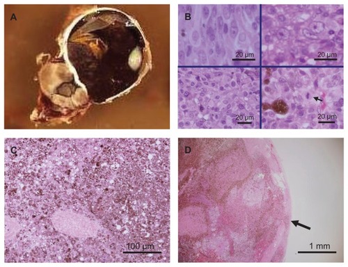 Figure 2 Histopathology findings of enucleated eye. (A) Macroscopic appearance. The eye had a massive choroidal tumor with exudative retinal detachment and multiple extraocular extensions into the orbit through the sclera. (B) Higher magnification of representative histological section showing spindle type A, spindle type B, and epithelioid cells, as well as cells with karyokinesis. Upper left: spindle type A cells. Upper right: epithelioid cells. Lower left: spindle type B cells. Lower right: cells presenting karyokinesis (arrow). (C) Necrosis of tumor cells. (D) Direct extraocular extension through the sclera (arrow).
