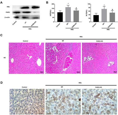 Figure 5 PAR2 knockdown alleviates HBx-induced liver injuries in a mouse model (n = 8 in each group). (A) The protein levels of HBx and PAR2 in PAR2-KO mice after injection of pcDNA3.1-HBx. (B) The levels of AST and ALT in PAR2-KO mice after injection of pcDNA3.1-HBx were measured by the corresponding commercial kits. *P < 0.05 vs the control mice group. #P < 0.05 vs the WT mice + pcDNA3.1-HBx group. (C) The HE staining and (D) immunohistochemistry assay of PAR2-KO mice after injection of pcDNA3.1-HBx.