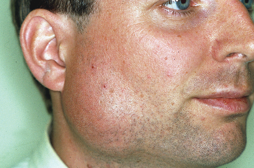 Figure 1. Acute bacterial sialadenitis: swollen and painful parotid gland with erythematous and warm overlying skin. This figure was previously published in the book “Mondziekten, Kaak-en Aangezichtschirurgie, Handboek voor Mondziekten, Kaak- en Aangezichtschirurgie” by A. Vissink, F.K.L. Spijkervet and co-authors. 2023| ISBN 9789023258629. Copyright permission from the publisher Uitgeverij Van Gorcum B.V. was obtained.