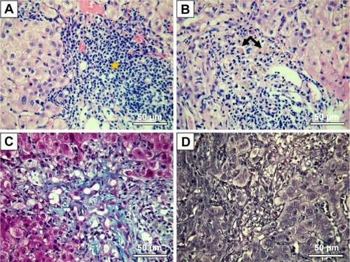 Figure 8 Interface hepatitis-like lesions and mild fibrosis in mice treated with Tween 20-GNPs.Notes: Pathology images are shown. (A) HE stain, massive lymphoplasmacytic infiltrate in the liver tissue (star) with interface hepatitis-like lesions. (B) HE stain, binucleated (left arrow) and glycogenated (right arrow) nuclei. (C) Masson’s-Trichrome staining, mild liver fibrosis. (D) Gomori stain – normal liver architecture.Abbreviations: GNPs, gold nanoparticles; HE, Hematoxylin-Eosin stain.