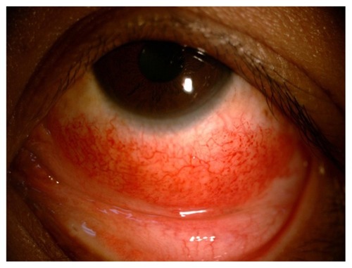 Figure 3 A 31-year-old woman who presented with a petechial hemorrhage above a conjunctival mass in the inferior area.