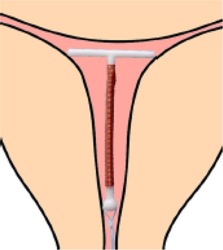 Figure 4 A narrow uterine cavity fitted by a trimmed T-shaped IUD with transverse arm length of 18 mm.